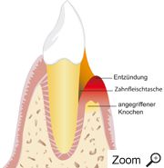 Angegriffener Knochen