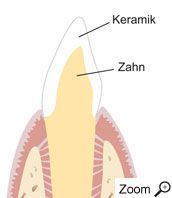 Keramikkrone